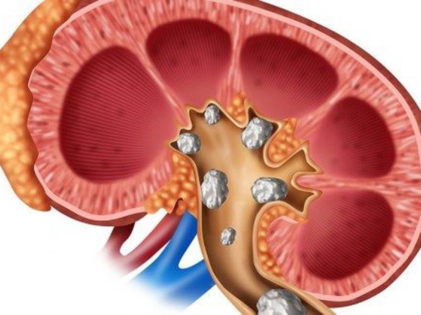 Si të hiqni gurët në veshka në mënyrë natyrale? 5 mënyra për të pastruar veshkat tuaja