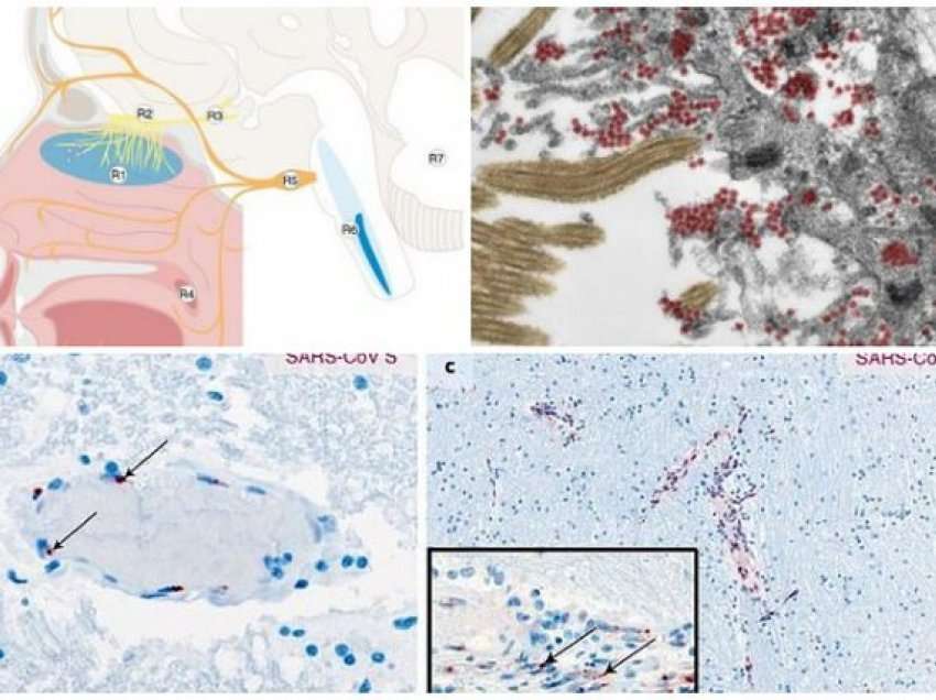 Përmes hundës dhe enëve të gjakut/ Studimi gjerman: Si futet koronavirusi në tru, pasojat e rënda tek pacientët