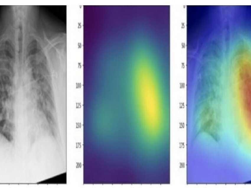 Shkencëtarët zhvillojnë mjetin që zbulon COVID-19 nga rrezet rëntgen me saktësi 83%