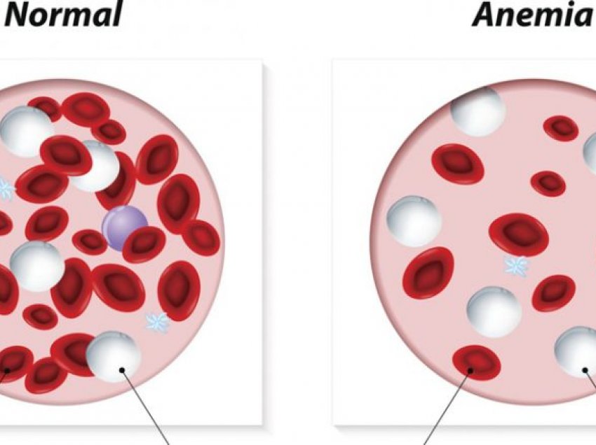 Anemia dhe ushqimet e duhura që luftojnë pagjakësinë