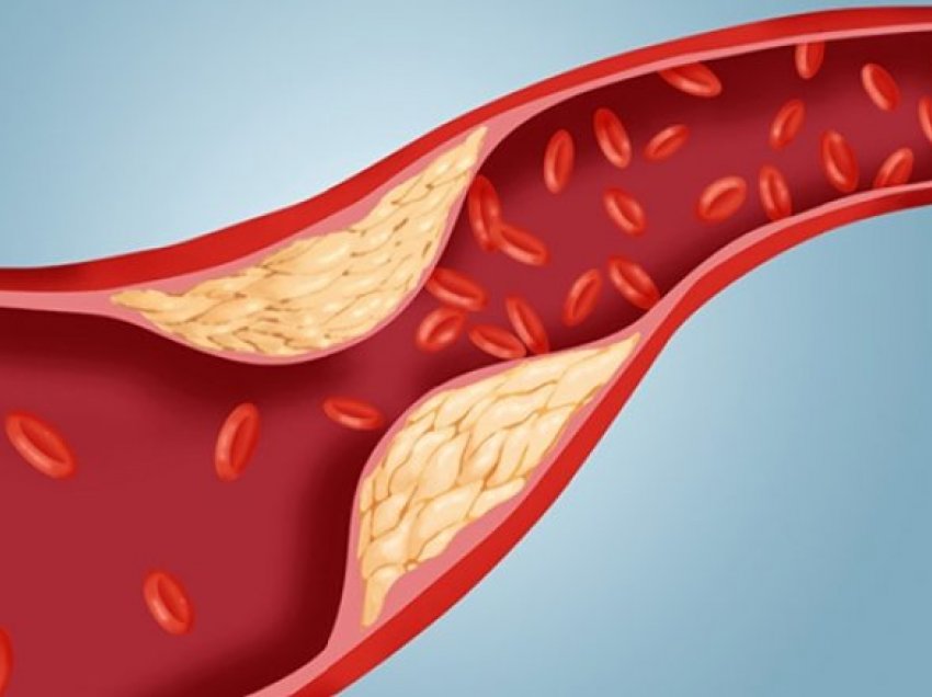 Mënyrat për ta parandaluar rritjen e kolesterolit të keq