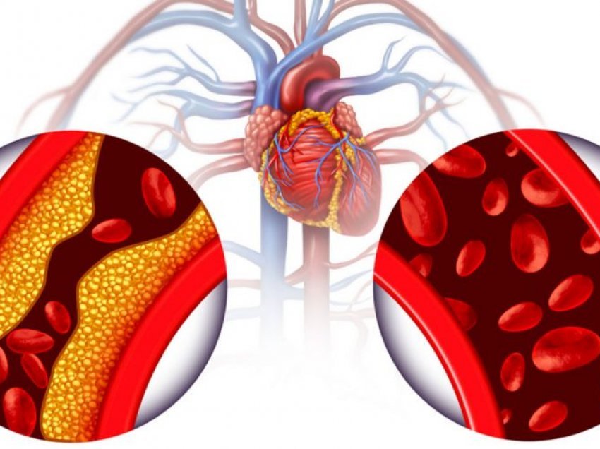 Si të ulni nivelet e larta të yndyrnave në gjak