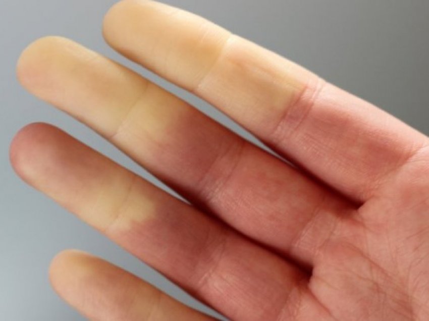 A keni dëgjuar për sindromën 'Raynaud'?