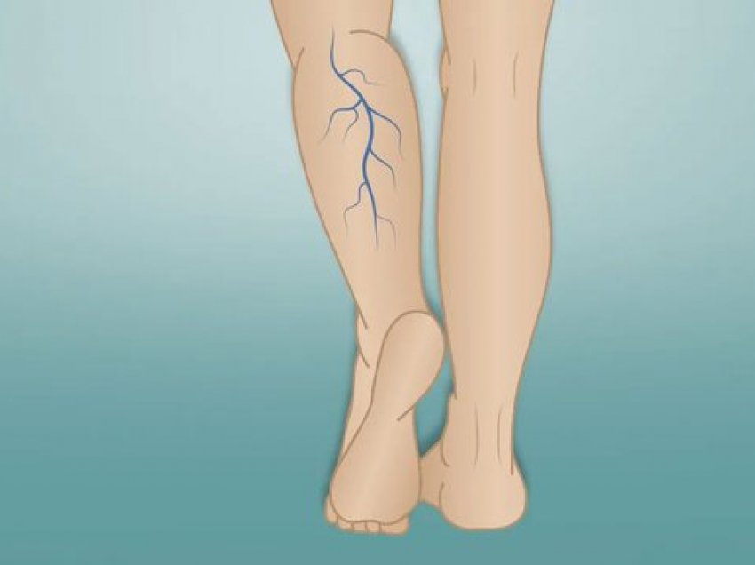 Nga shtatzënia tek ushqimet super të kripura, e dini cilët janë 5 shkaktarët kryesorë të variçeve?