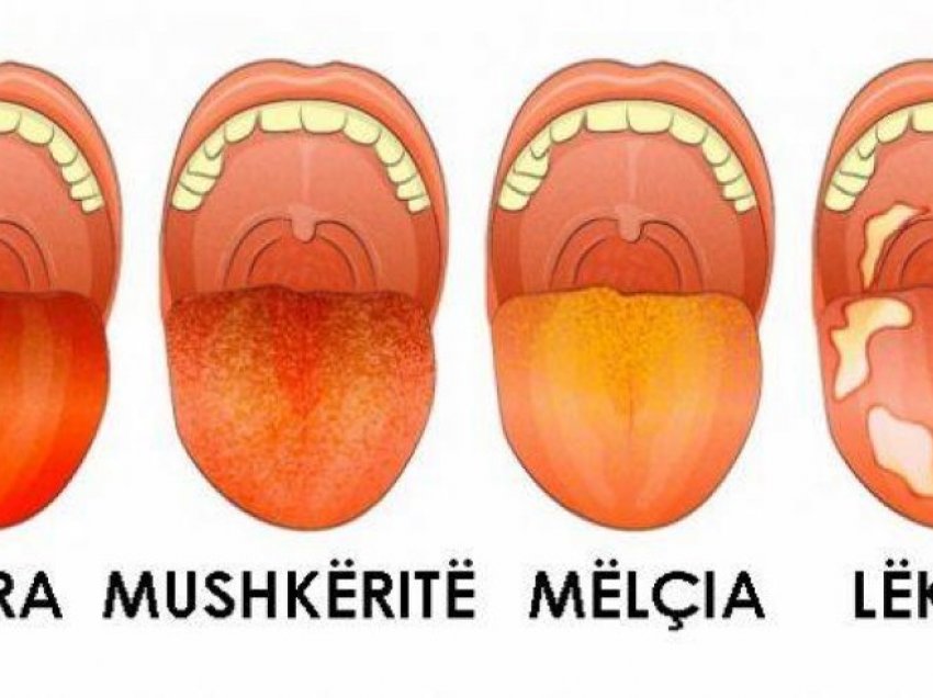 Nëse gjuha juaj ka këtë ngjyrë, keni këtë problem shëndetësor