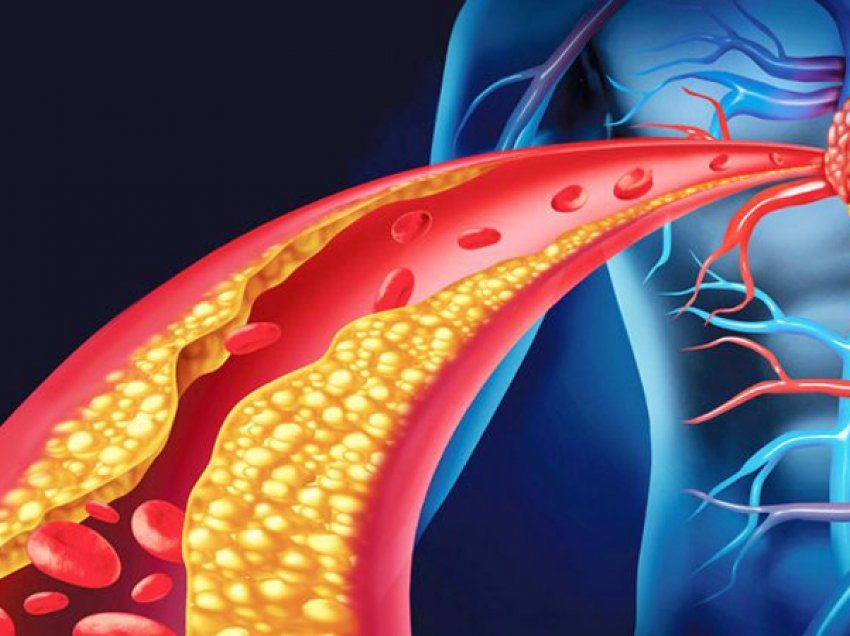 Dëmet që i shkakton kolesteroli i lartë zemrës dhe trurit/ Kujdesi që ju duhet