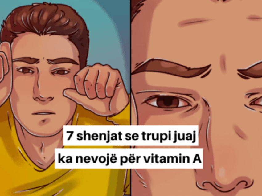 Këto shenja tregojnë se trupi ka nevojë urgjente për vitaminë A