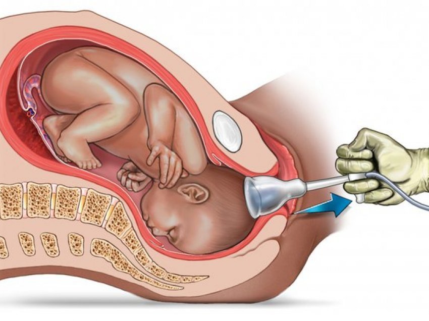 Lindja e asistuar me forceps dhe vakum; Në cilat raste kryhet