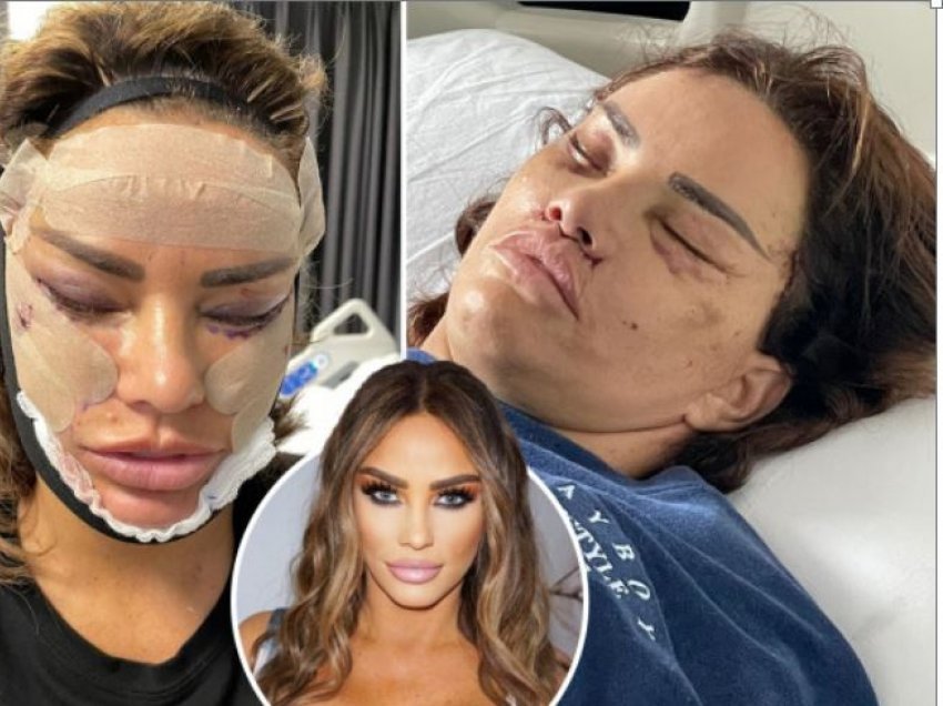 Katie Price zbuloi se ajo dukej si një “përbindësh” pas raundit të saj të fundit të operacioneve plastike