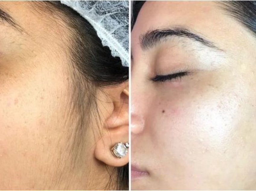 Dermaplaning: Përfitimet, rreziqet dhe a mund ta bëni vetë në shtëpi?