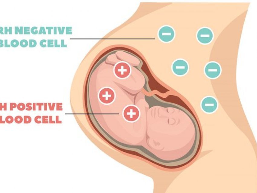 Shtatzënia dhe mospërputhja e faktorit Rhezus; Çfarë duhet të dini