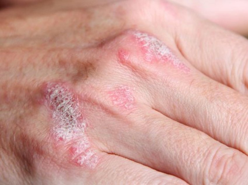 Ujë deti e kastravec, 5 trajtime efikase shtëpie për psoriasis