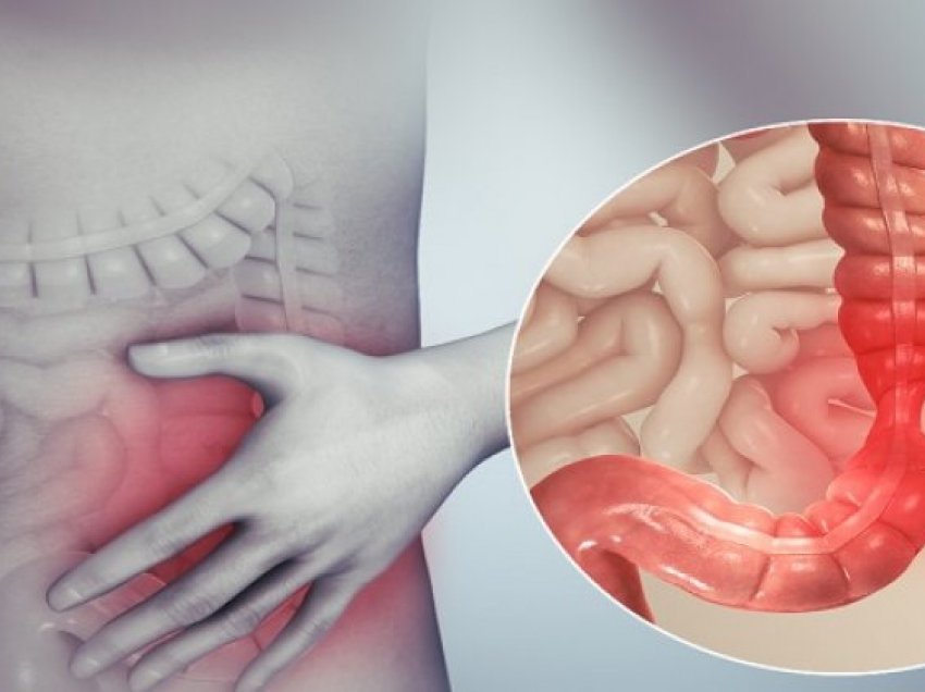 Ushqimet më të mira për zbutjen e simptomave të sëmundjes së Crohn-it