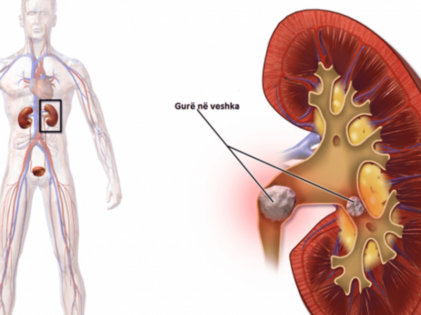 Njerëzit me gurë në veshka mund të vuajnë nga osteoporoza dhe frakturat e kockave