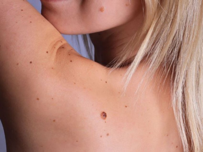 Çfarë është Melanoma, si të zbuloni shpejt dhe të parandaloni kancerin e lëkurës