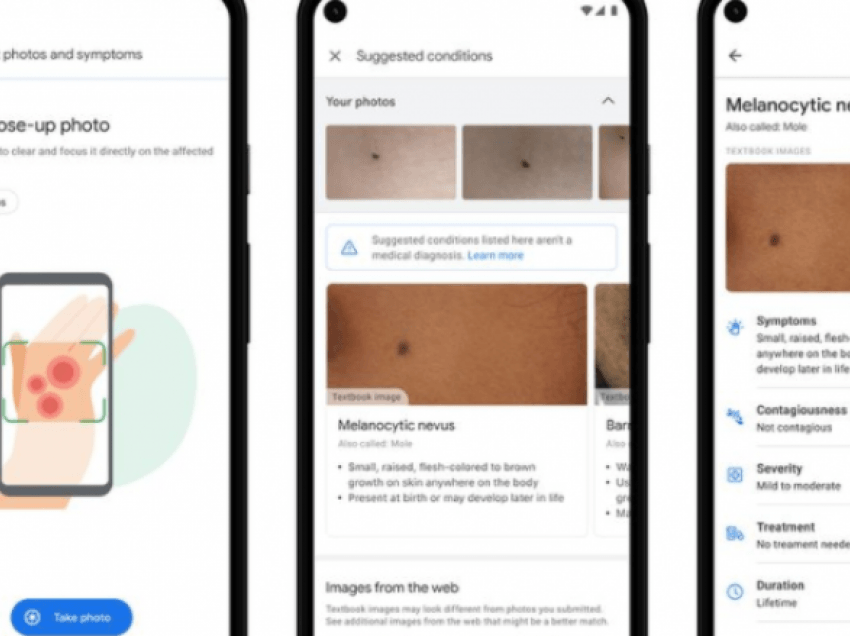 Një mjet në Google mund t’i ndihmojë njerëzit të identifikojnë problemet në lëkurë