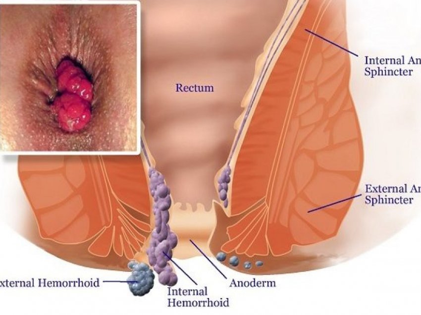 Si t'ia dilni mbanë me hemorroidet?
