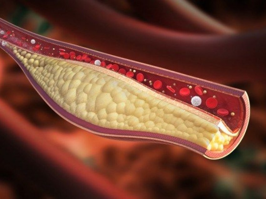 Lëngu që ju ndihmon të zhbllokoni arteriet