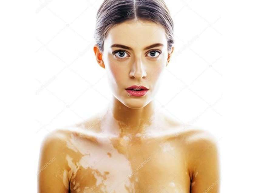 Vitiligo – një sëmundje e lëkurës që shkakton humbje të pigmentit