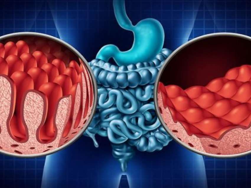 Sëmundja celiake dhe intoleranca ndaj glutenit nuk janë e njëjta