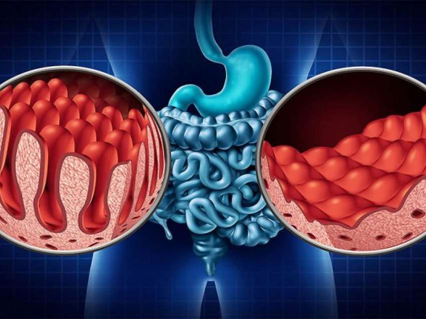 Sëmundja celiake dhe intoleranca ndaj glutenit nuk janë e njëjta, njëra është shumë më e rrezikshme