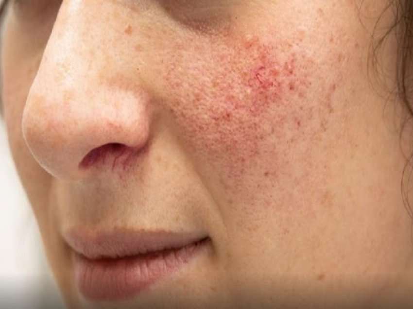 ​Cilat janë shkaqet e mundshme të rosacea