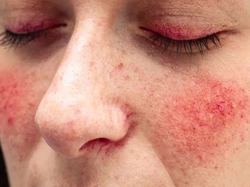 Rosacea dhe shkaqet e mundshme