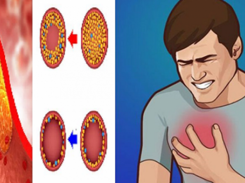 Këto janë 3 shenjat paralajmëruese të kolesterolit të lartë, ja çfarë rrezikoni