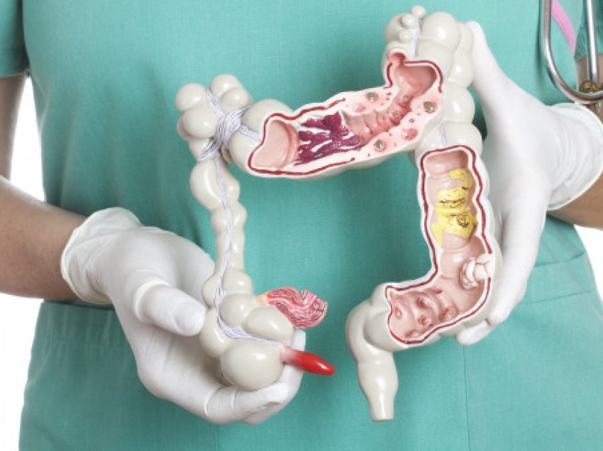 Kanceri kolorektal i moshave të reja, shqetësim i ri për onkologët