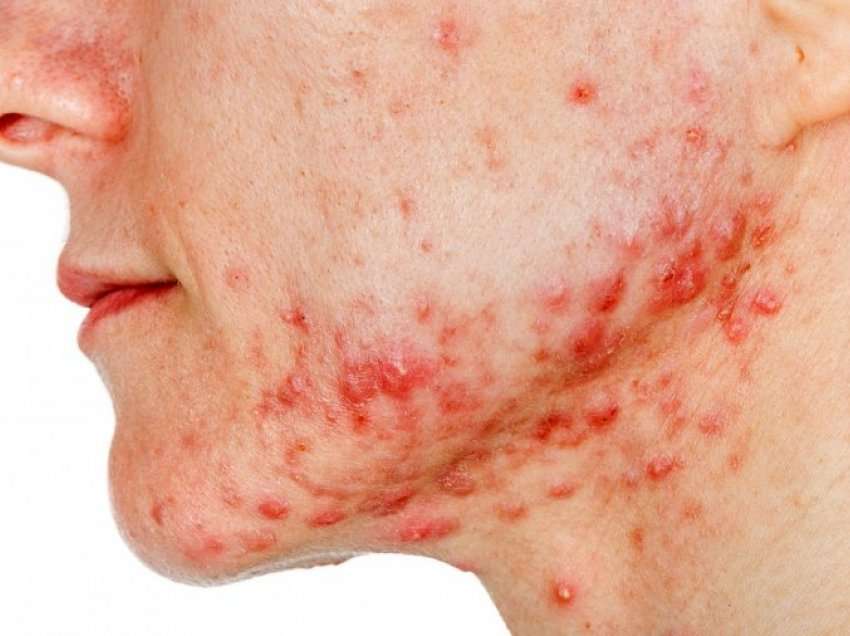 Për të gjithë ata të cilët vuajnë nga aknet, ja ku po iu sjellim disa trajtime efikase të rekomanduara nga dermatologët