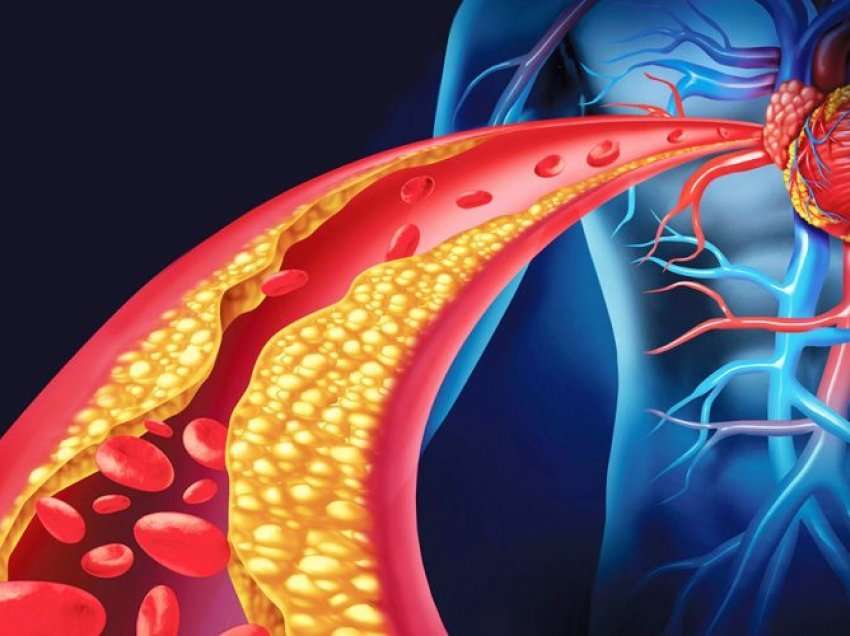 Dëmet që i shkakton kolesteroli i lartë zemrës dhe trurit