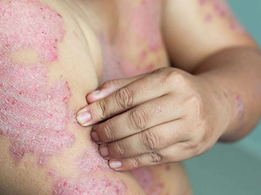 Çka është Psoriasis?