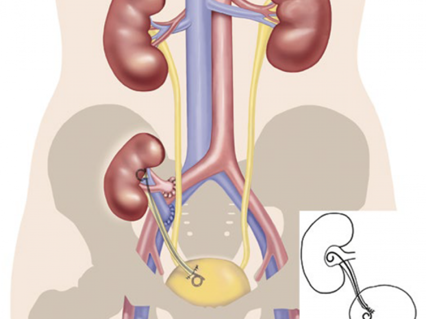 Çfarë është një transplant?