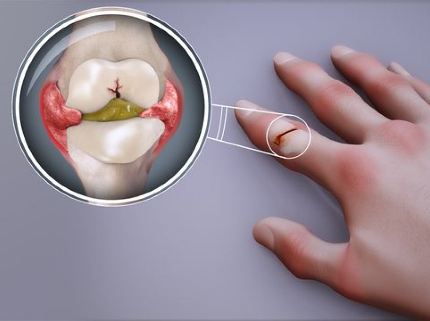 3 ushqimet që duhen konsumuar çdo ditë nëse vuani nga artriti reumatoid