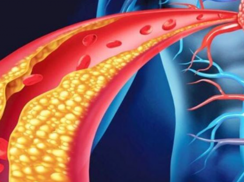 Kjo është simptoma kryesore që tregon se keni kolesterol të lartë