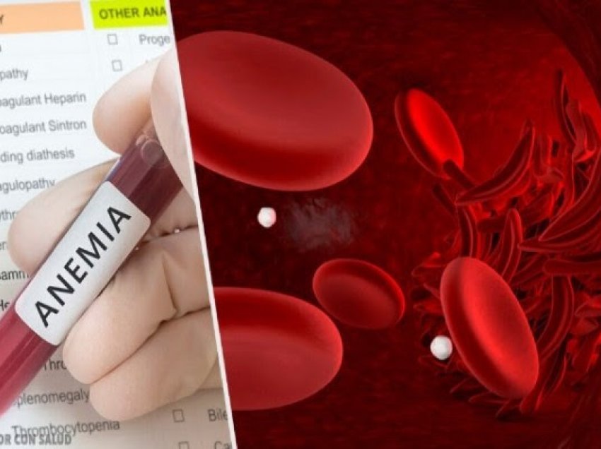 ​Çfarë është dhe si trajtohet anemia