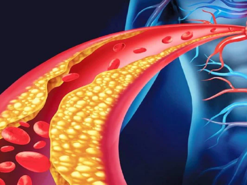 Kolesteroli i lartë/ Yndyra nuk është fajtori, zbuloni armikun e vërtetë