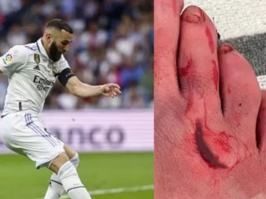 Benzema luajti me këmbë të prerë