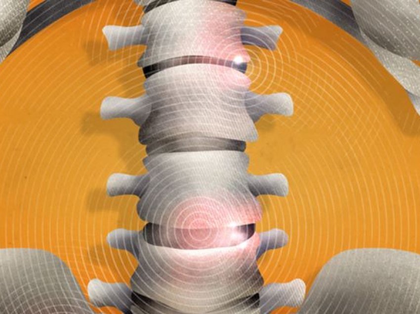 Spondiloartriti, sëmundja që prek nyjat e shtyllës kurrizore