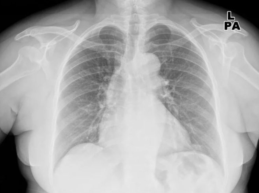 A mundet inteligjenca artificiale t’i kalojë radiologët në zbulimin e problemeve të mushkërive?