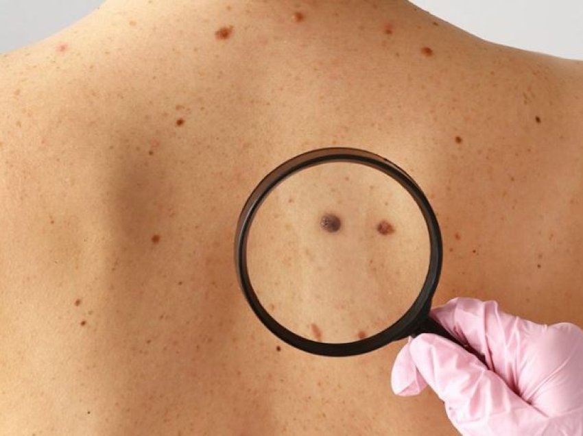 Melanoma/ 10 mite dhe të vërteta për kancerin e lëkurës