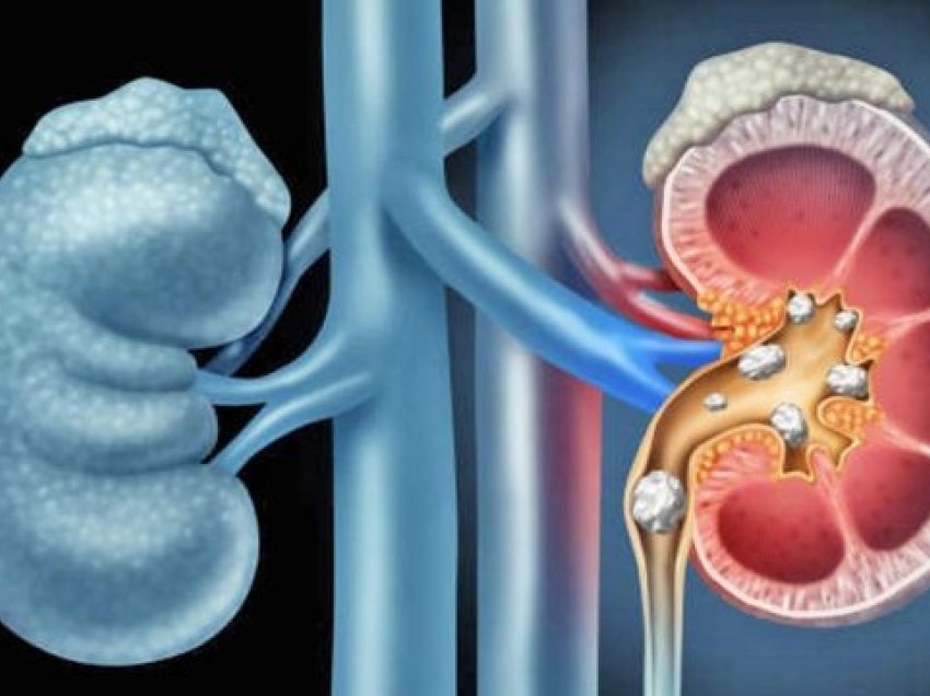 Si të përshpejtoni nxjerrjen e gurëve të veshkave nga trupi! Këshillat që ju nevojiten, ja kur duhet t’i drejtoheni mjekut