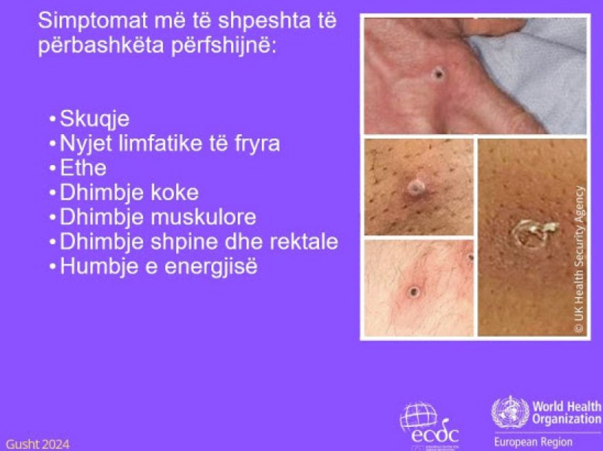 ​IKSHPK: Në Kosovë nuk është raportuar asnjë rast i dyshimtë me “mpox”