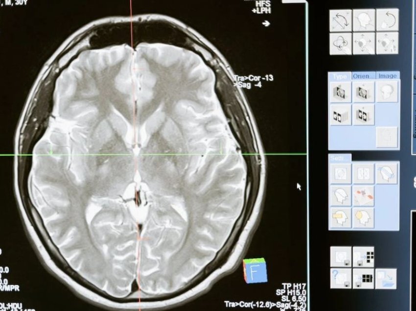 Zbulimi i hershëm i demencës identifikon proteinat në gjak të lidhura me rrezikun