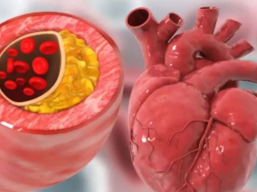 5 këshillat kryesore për të zhbllokuar arteriet në mënyrë natyrale dhe për të parandaluar goditjen në tru