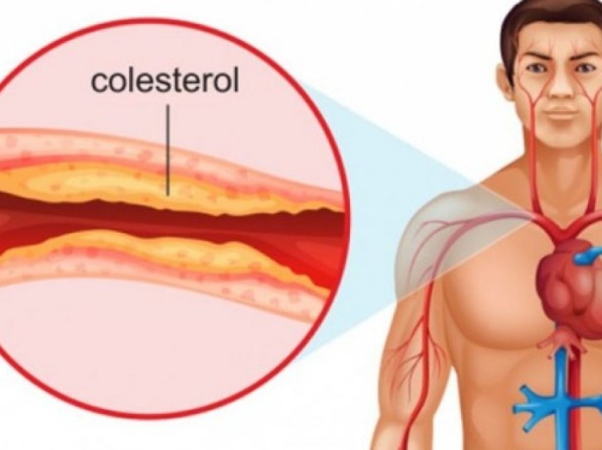 Shenjat dhe simptomat e kolesterolit të lartë pasi shumë njerëz i anashkalojne