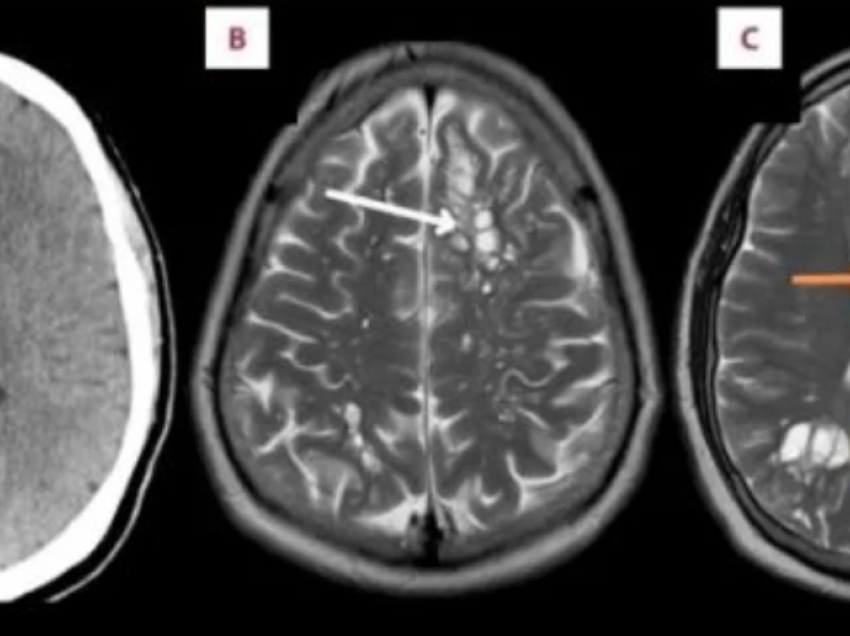 Ankohej nga dhimbja e kokës së vazhdueshme, mjekët i gjejnë vezë krimbash në trurin e tij: Kujdes nga mishi i derrit…