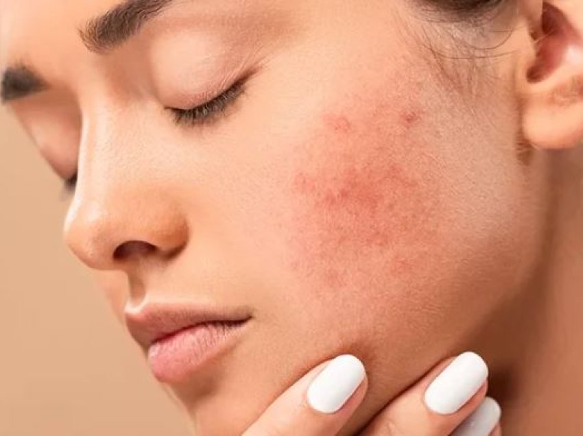 Çfarë grimi të përdorni nëse keni ekzemë? Këshilla nga mjekë dermatologë