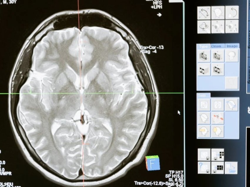 Ekografia e fokusuar premton trajtimin e Alzheimerit duke reduktuar pllakat amiloide